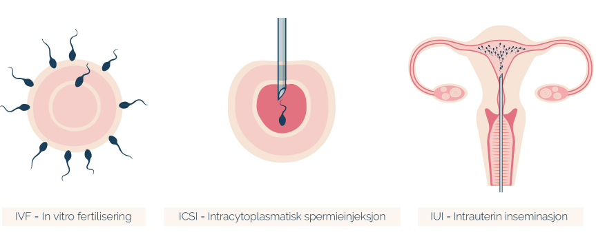 Tre befruktningsmetoder: IVF, ICSI og IUI