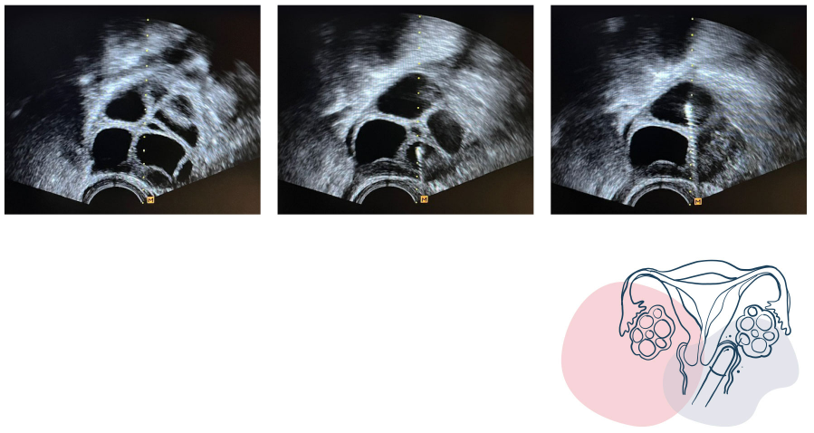 Ultralydbilder av follikler og skjematisk fremstilling av ultralydveiledet egguttak
