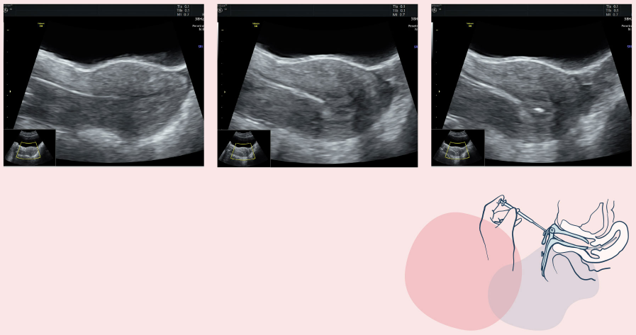 Ultralydbilder ved embryotilbakesetting og skjematisk fremstilling av kateter som fører embryoet inn i livmoren